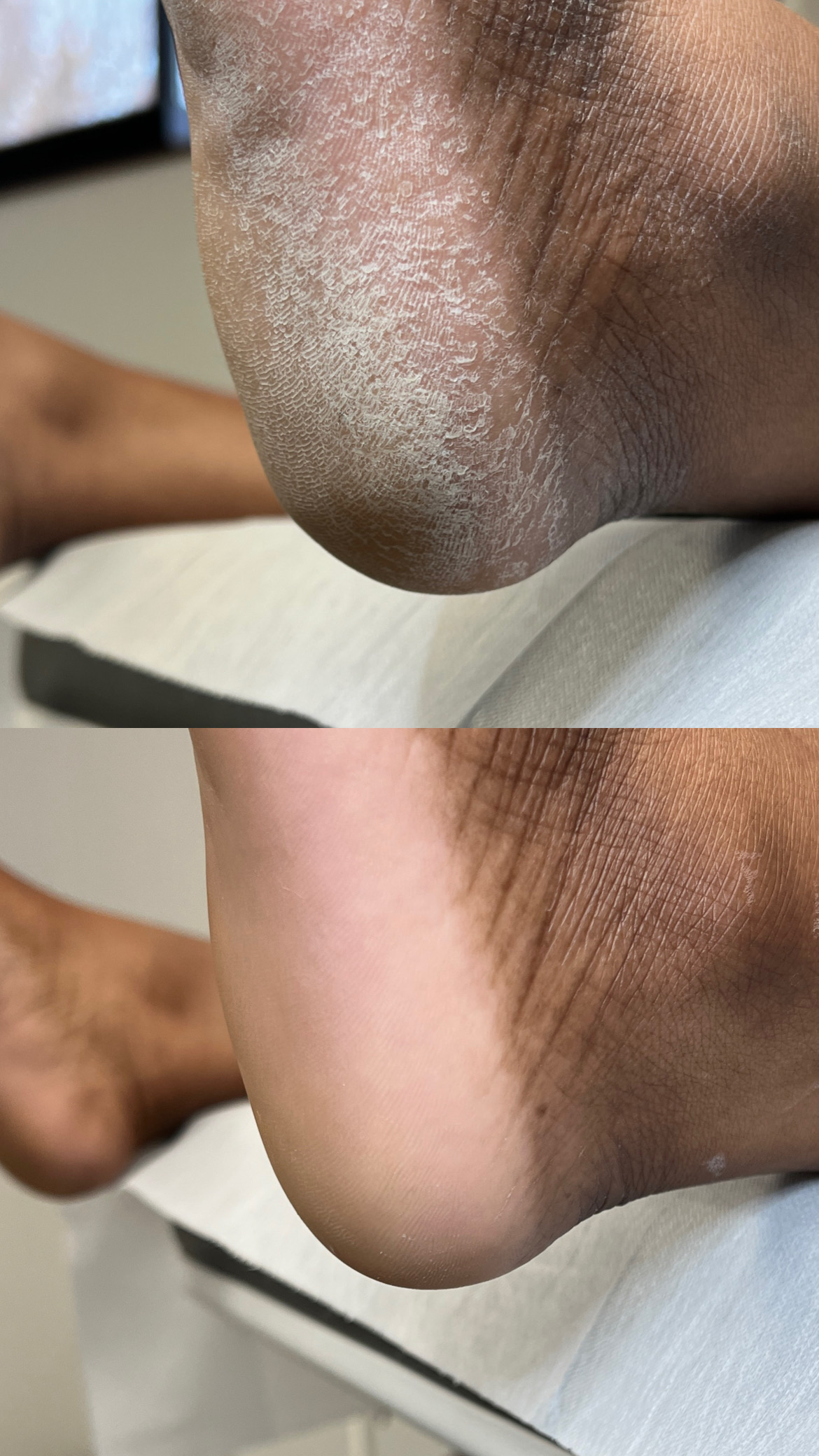 Heel care before and after, example 1