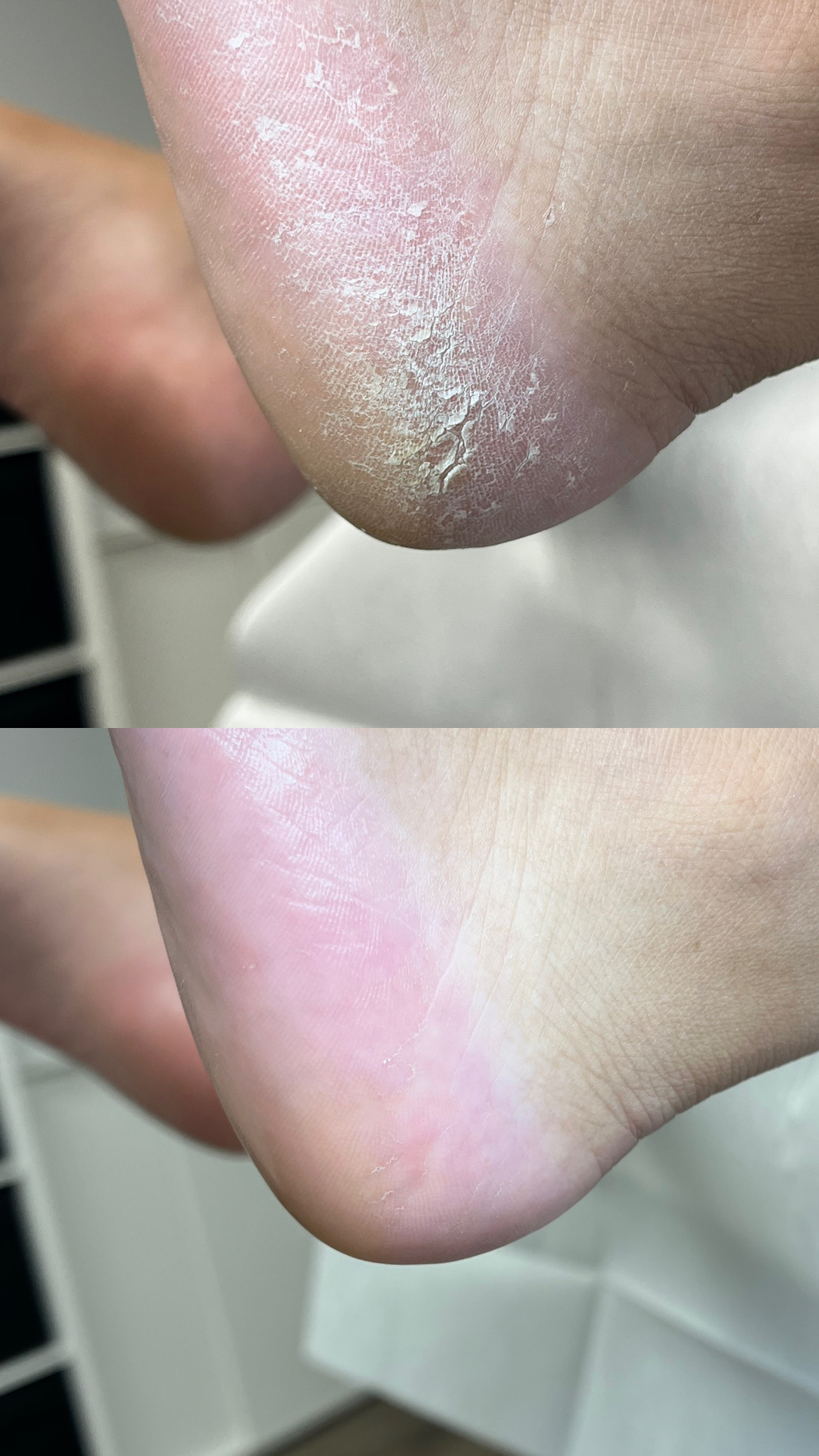 Heel care before and after, example 2