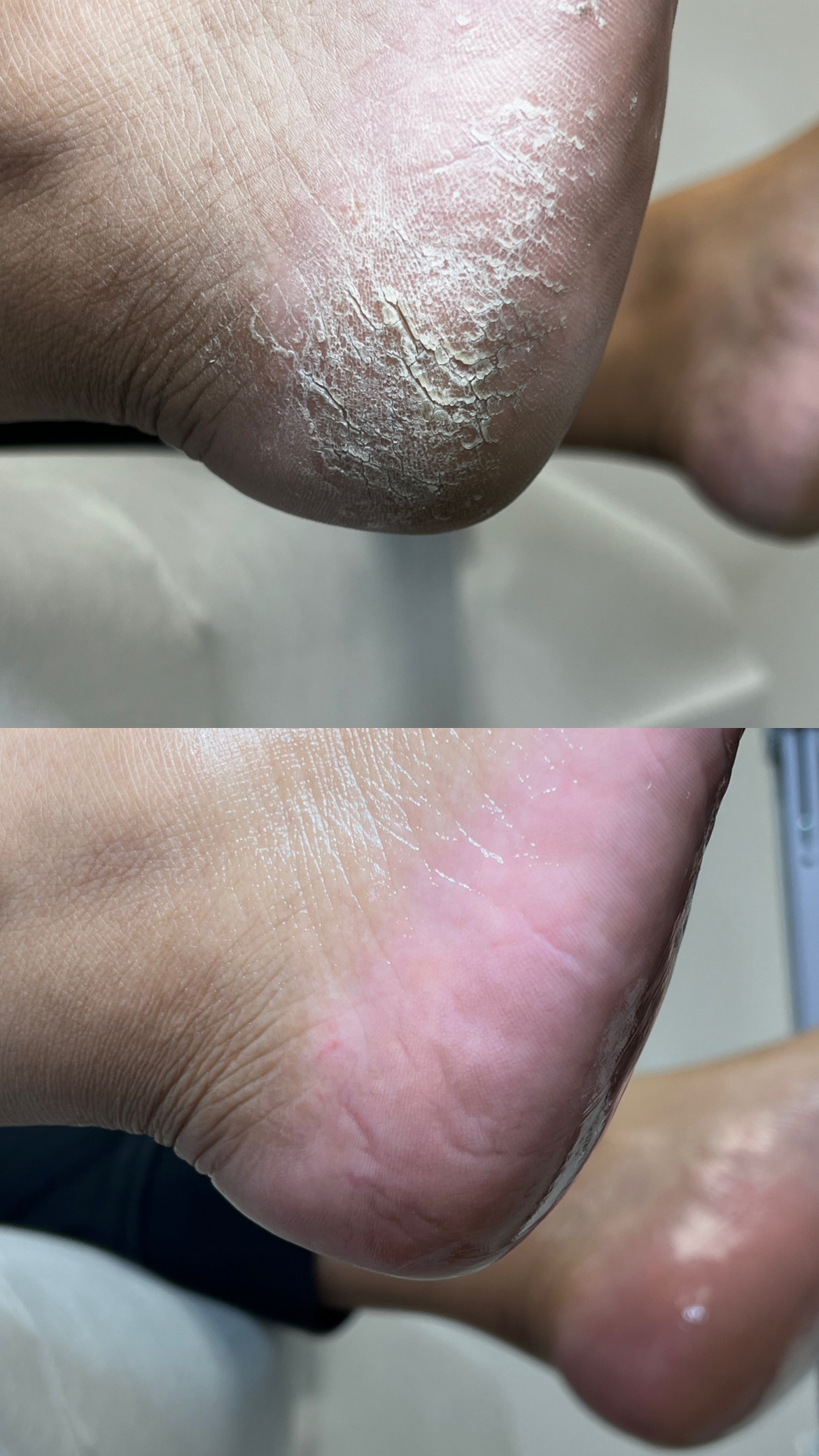 Heel care before and after, example 3