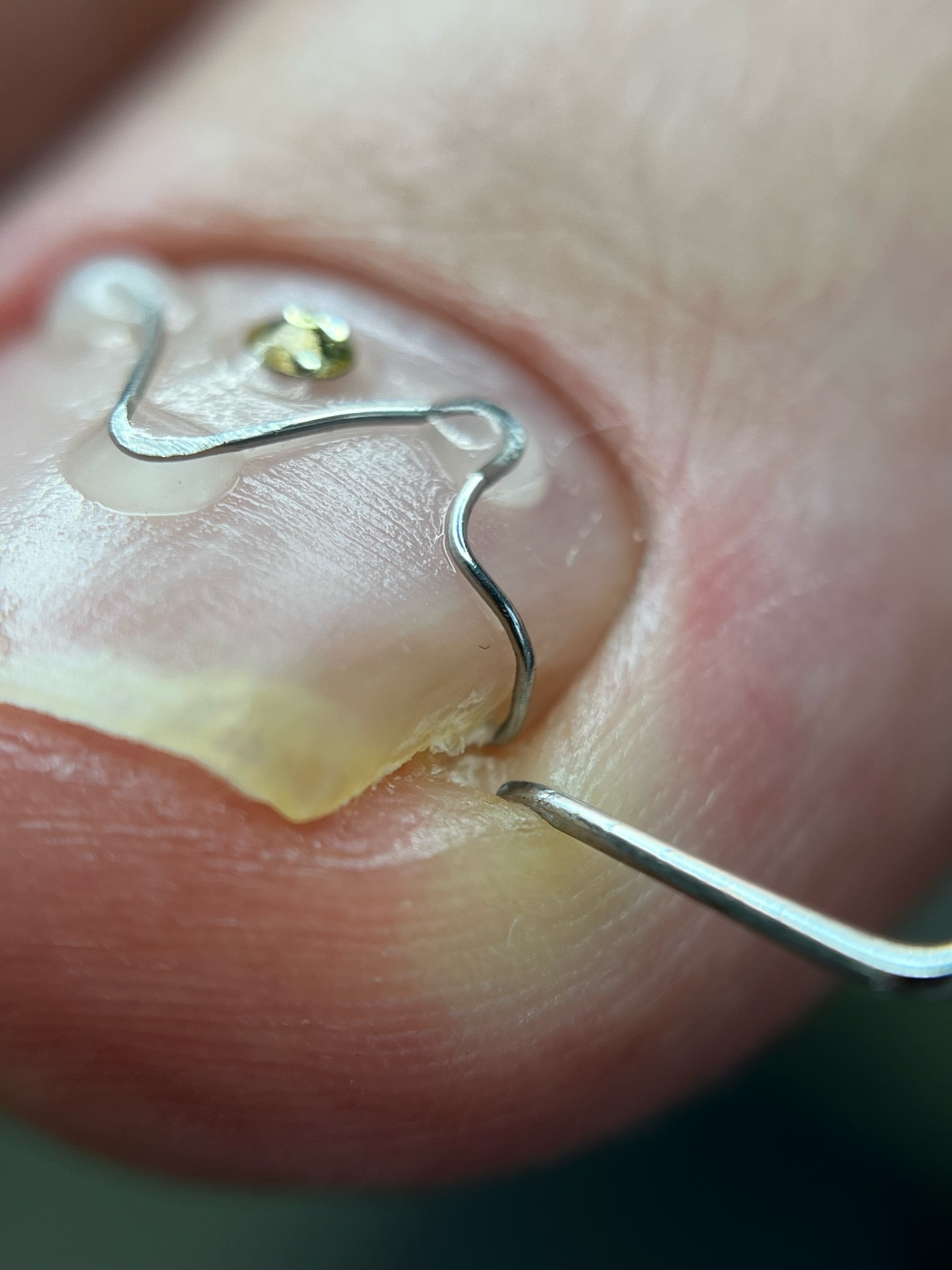 Close-up of a corrective wire attached to a toenail