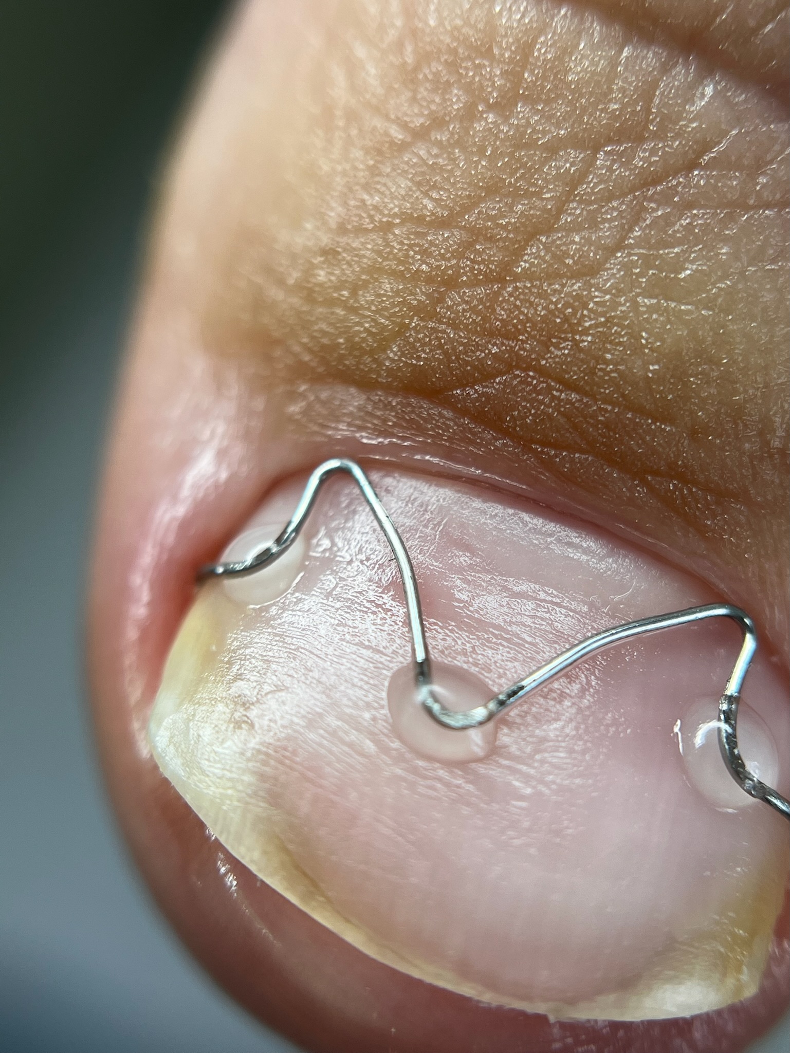 Detailed view of a shaped wire correction system