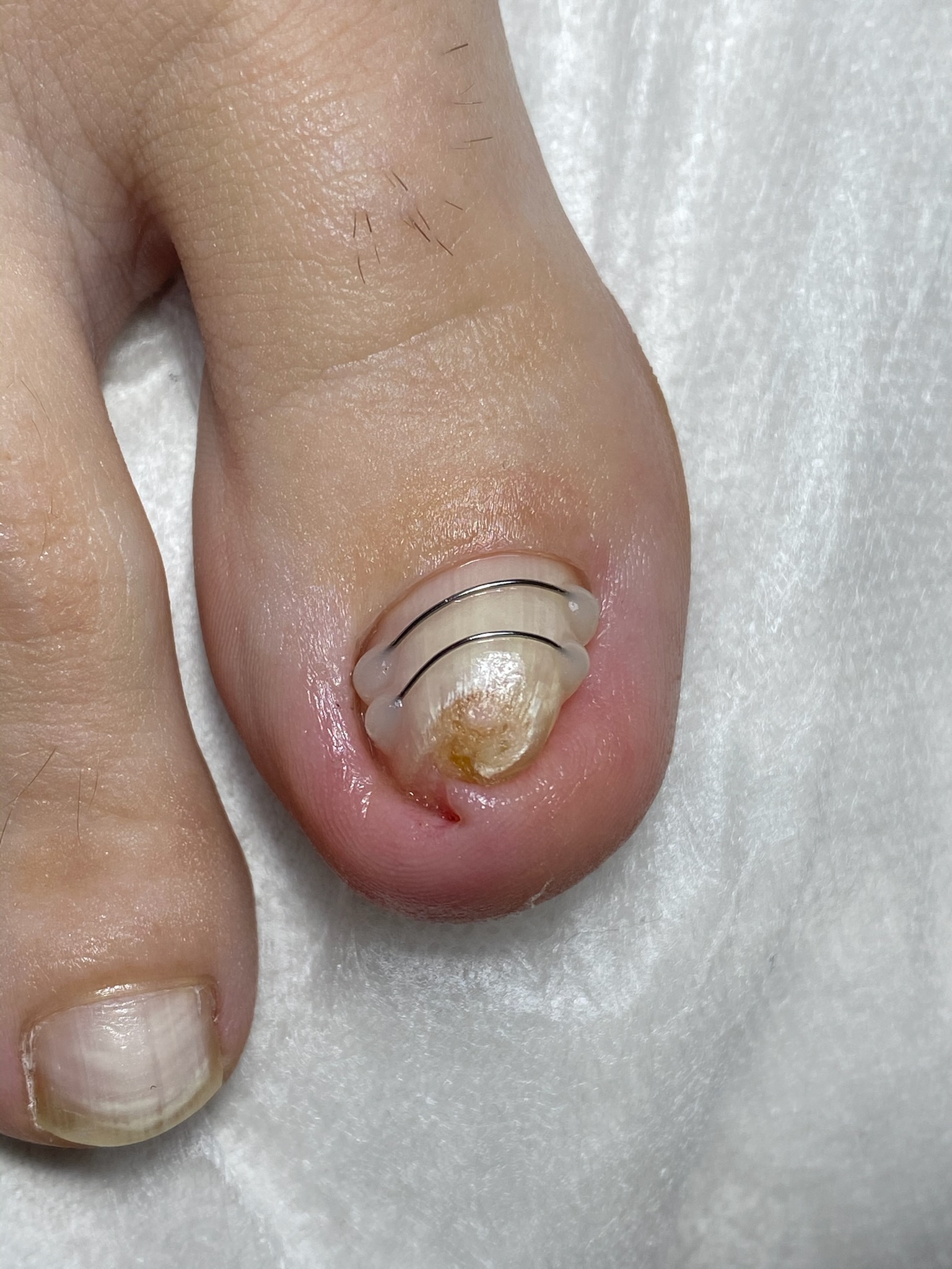 Two corrective wires fitted to a toenail