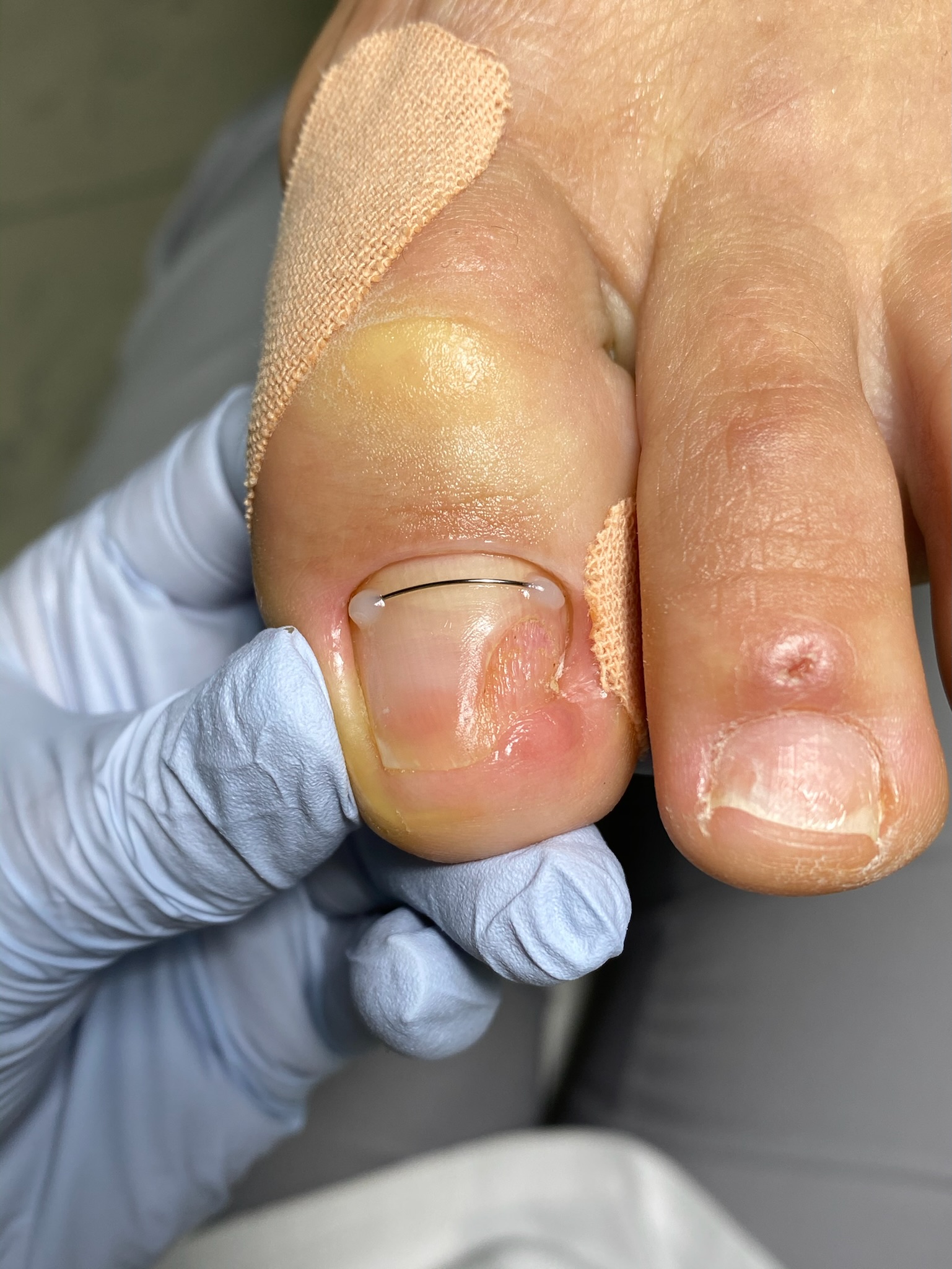Corrective wire fitted to a toenail with protective taping