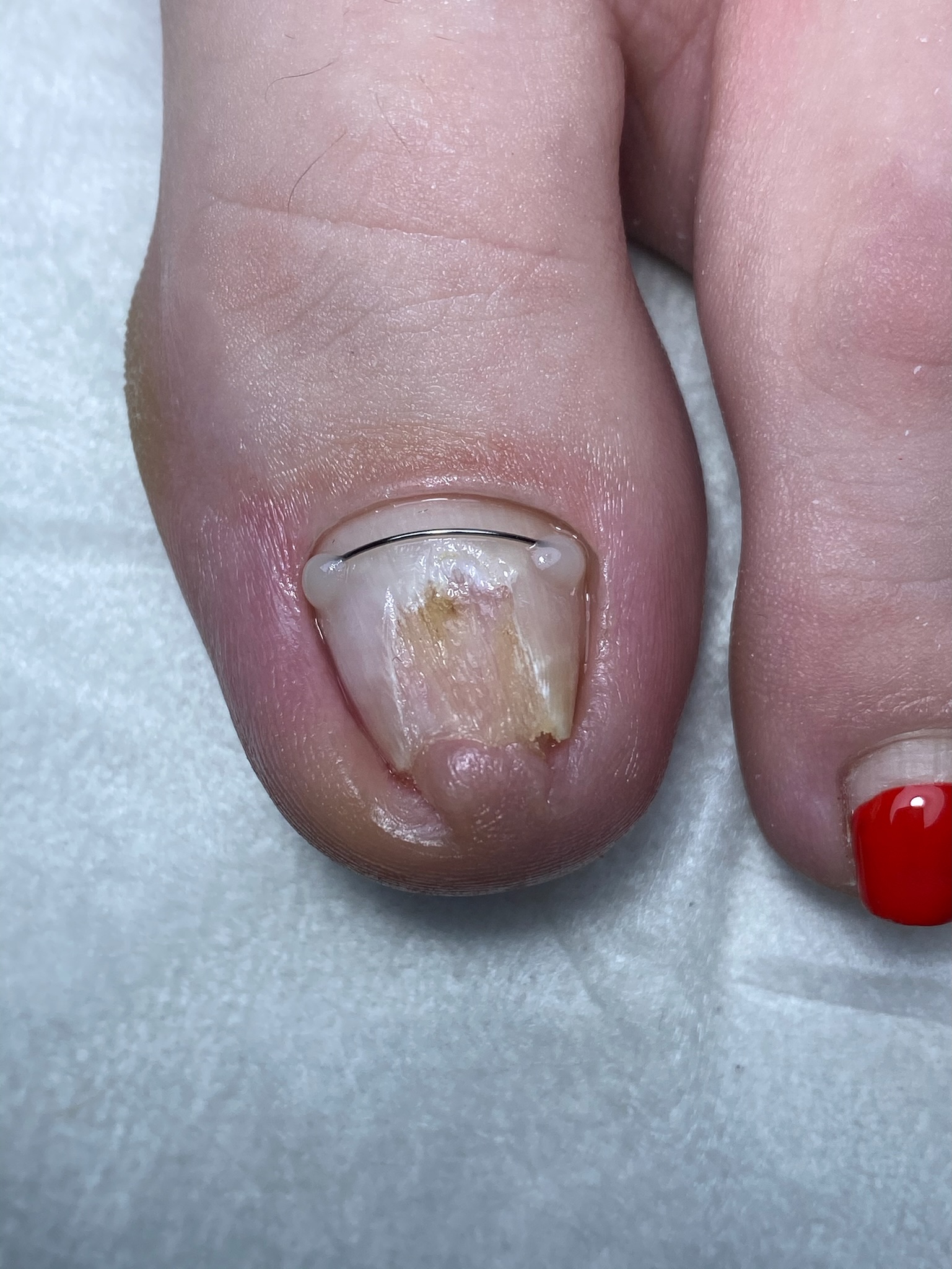 Close-up of a corrective wire on a deformed toenail