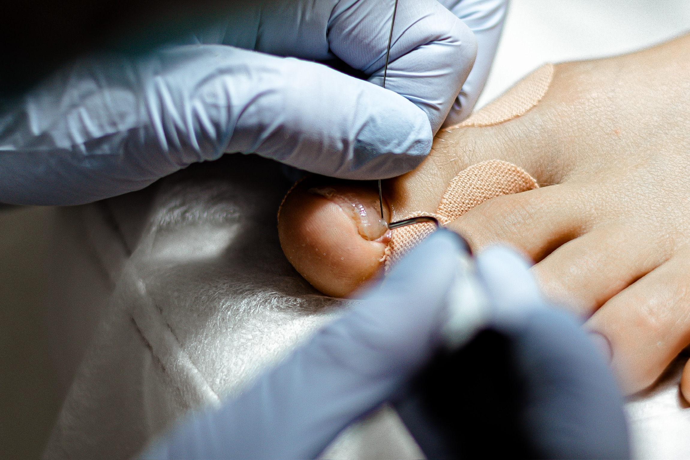 Close-up of corrective wire application during foot care